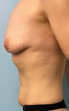 Breast Augmentation Before Photo by Julia Spears, MD, FACS; ,  - Case 50332