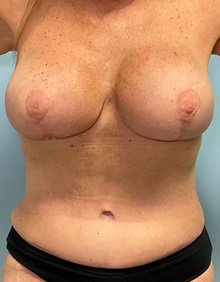 Tummy Tuck After Photo by Julia Spears, MD, FACS; ,  - Case 50341