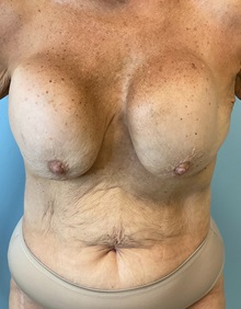 Tummy Tuck Before Photo by Julia Spears, MD, FACS; ,  - Case 50341