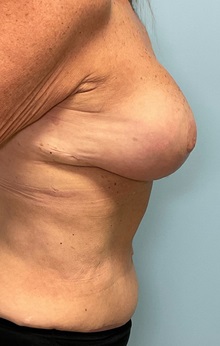 Tummy Tuck After Photo by Julia Spears, MD, FACS; ,  - Case 50341