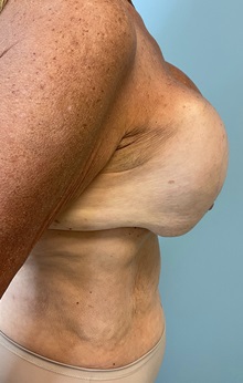 Tummy Tuck Before Photo by Julia Spears, MD, FACS; ,  - Case 50341