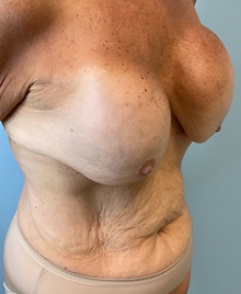 Tummy Tuck Before Photo by Julia Spears, MD, FACS; ,  - Case 50341