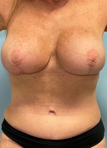 Breast Implant Revision After Photo by Julia Spears, MD, FACS; ,  - Case 50340