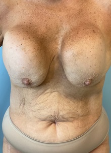 Breast Implant Revision Before Photo by Julia Spears, MD, FACS; ,  - Case 50340