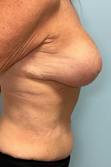 Breast Implant Revision After Photo by Julia Spears, MD, FACS; ,  - Case 50340