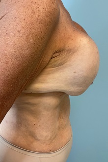 Breast Implant Revision Before Photo by Julia Spears, MD, FACS; ,  - Case 50340