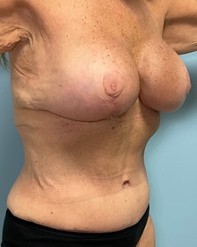 Breast Implant Revision After Photo by Julia Spears, MD, FACS; ,  - Case 50340