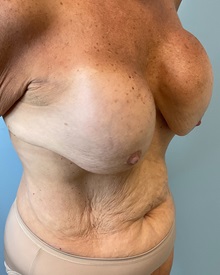 Breast Implant Revision Before Photo by Julia Spears, MD, FACS; ,  - Case 50340