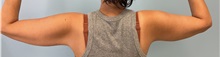 Arm Lift After Photo by Julia Spears, MD, FACS; ,  - Case 50349