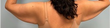 Arm Lift Before Photo by Julia Spears, MD, FACS; ,  - Case 50349
