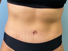 Tummy Tuck After Photo by Julia Spears, MD, FACS; ,  - Case 50351