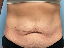 Tummy Tuck Before Photo by Julia Spears, MD, FACS; ,  - Case 50351