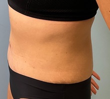 Tummy Tuck After Photo by Julia Spears, MD, FACS; ,  - Case 50351
