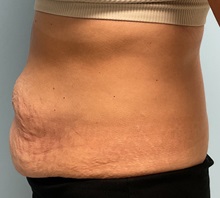 Tummy Tuck Before Photo by Julia Spears, MD, FACS; ,  - Case 50351