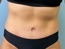Liposuction After Photo by Julia Spears, MD, FACS; ,  - Case 50352