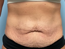 Liposuction Before Photo by Julia Spears, MD, FACS; ,  - Case 50352