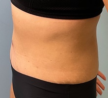 Liposuction After Photo by Julia Spears, MD, FACS; ,  - Case 50352