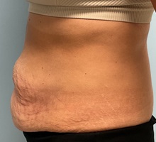 Liposuction Before Photo by Julia Spears, MD, FACS; ,  - Case 50352