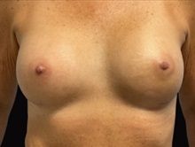 Breast Augmentation After Photo by Julia Spears, MD, FACS; ,  - Case 50354