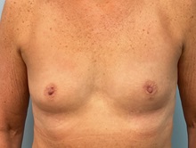 Breast Augmentation Before Photo by Julia Spears, MD, FACS; ,  - Case 50354