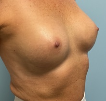 Breast Augmentation After Photo by Julia Spears, MD, FACS; ,  - Case 50354
