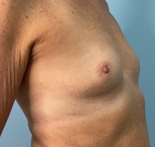 Breast Augmentation Before Photo by Julia Spears, MD, FACS; ,  - Case 50354