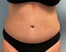 Liposuction After Photo by Julia Spears, MD, FACS; ,  - Case 50367