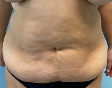 Liposuction Before Photo by Julia Spears, MD, FACS; ,  - Case 50367