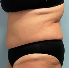 Liposuction After Photo by Julia Spears, MD, FACS; ,  - Case 50367
