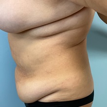 Liposuction Before Photo by Julia Spears, MD, FACS; ,  - Case 50367