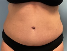 Tummy Tuck After Photo by Julia Spears, MD, FACS; ,  - Case 50366