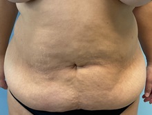 Tummy Tuck Before Photo by Julia Spears, MD, FACS; ,  - Case 50366