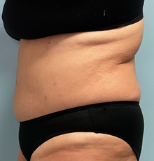 Tummy Tuck After Photo by Julia Spears, MD, FACS; ,  - Case 50366