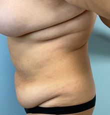 Tummy Tuck Before Photo by Julia Spears, MD, FACS; ,  - Case 50366