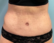 Tummy Tuck After Photo by Julia Spears, MD, FACS; ,  - Case 50376