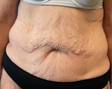 Tummy Tuck Before Photo by Julia Spears, MD, FACS; ,  - Case 50376