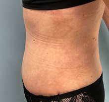 Tummy Tuck After Photo by Julia Spears, MD, FACS; ,  - Case 50376