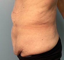 Tummy Tuck Before Photo by Julia Spears, MD, FACS; ,  - Case 50376