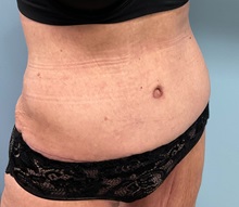 Tummy Tuck After Photo by Julia Spears, MD, FACS; ,  - Case 50376