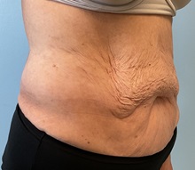 Tummy Tuck Before Photo by Julia Spears, MD, FACS; ,  - Case 50376