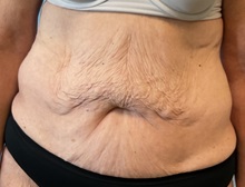Liposuction Before Photo by Julia Spears, MD, FACS; ,  - Case 50377