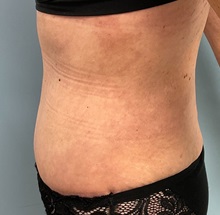 Liposuction After Photo by Julia Spears, MD, FACS; ,  - Case 50377