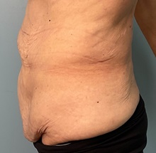 Liposuction Before Photo by Julia Spears, MD, FACS; ,  - Case 50377