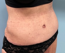 Liposuction After Photo by Julia Spears, MD, FACS; ,  - Case 50377