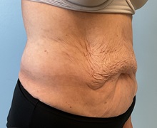 Liposuction Before Photo by Julia Spears, MD, FACS; ,  - Case 50377