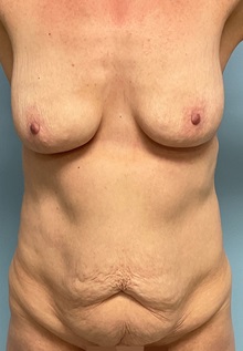 Tummy Tuck Before Photo by Julia Spears, MD, FACS; ,  - Case 50379