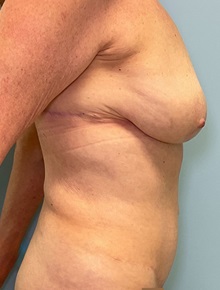 Tummy Tuck After Photo by Julia Spears, MD, FACS; ,  - Case 50379