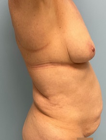Tummy Tuck Before Photo by Julia Spears, MD, FACS; ,  - Case 50379