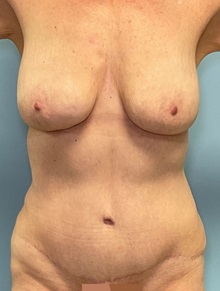 Liposuction After Photo by Julia Spears, MD, FACS; ,  - Case 50380