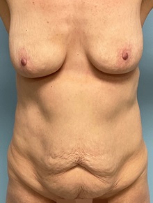 Liposuction Before Photo by Julia Spears, MD, FACS; ,  - Case 50380